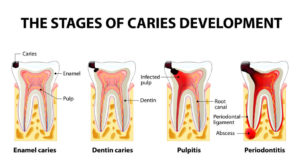 Stages of dental caries