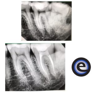 Root Canal Start and Finish