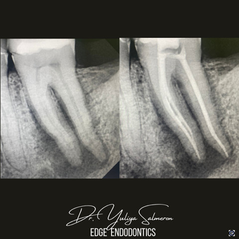 Laser Molar Root Canal